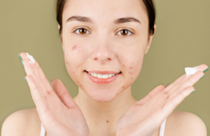 Busting myths for Acne Awareness Month