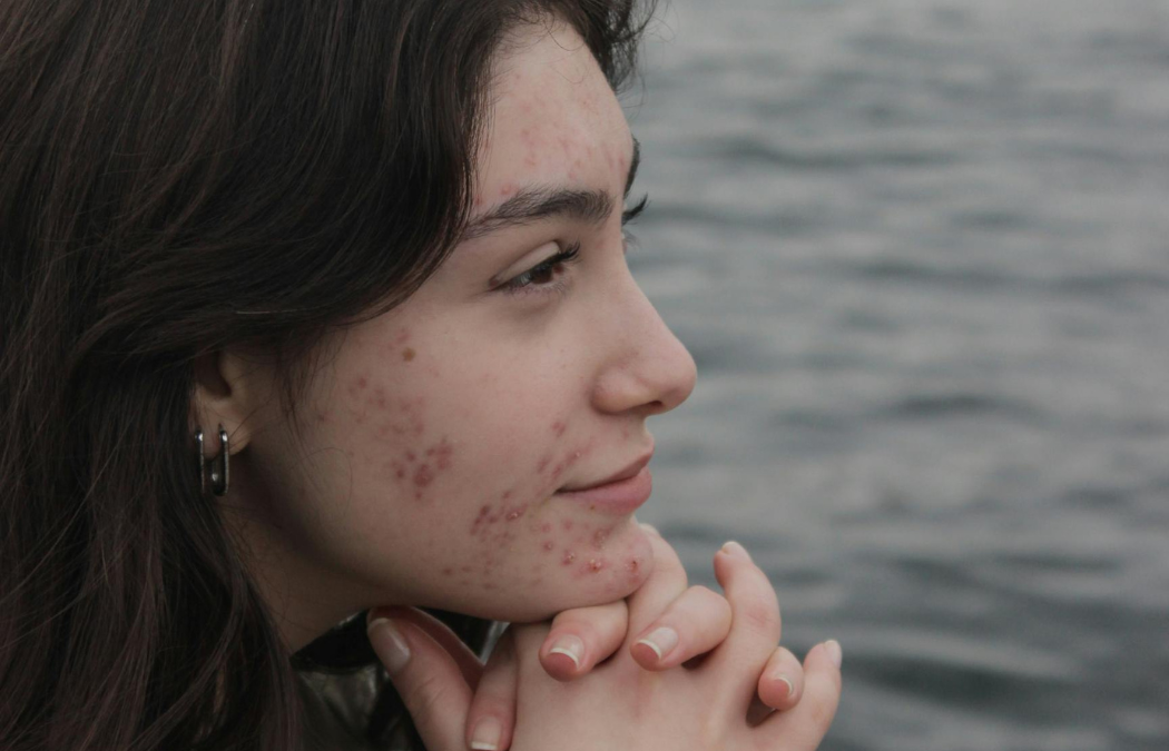 An effective treatment for acne scarring